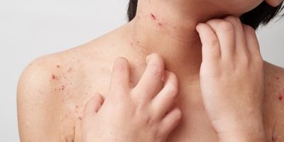 アトピー肌の改善には肌のバリア機能を高める事が大切