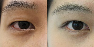 連休はプチ整形のチャンス! ちょっとのお直しでかなりキレイになる美容医療