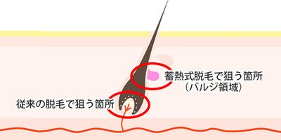 痛くない&早いと言われる蓄熱式脱毛のウソホント