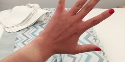 日焼けしやすい人と日焼けしにくい人の違いと特徴