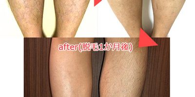 話題の蓄熱式脱毛は本当に痛くない?すね毛でその効果を体験!