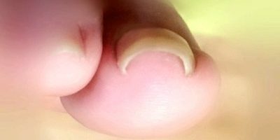 巻き爪がコロナで増加?!その原因と対策法は?
