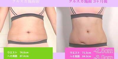 脂肪を凍らせて痩せる!? 最新医療ダイエット「クルスカ」の効果とは